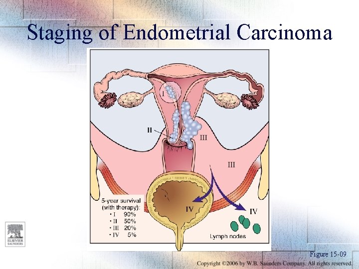 Staging of Endometrial Carcinoma Figure 15 -09 