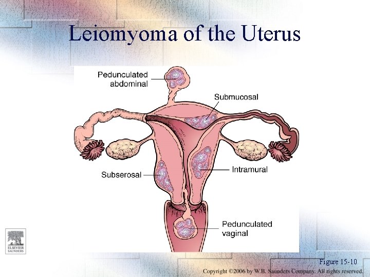 Leiomyoma of the Uterus Figure 15 -10 