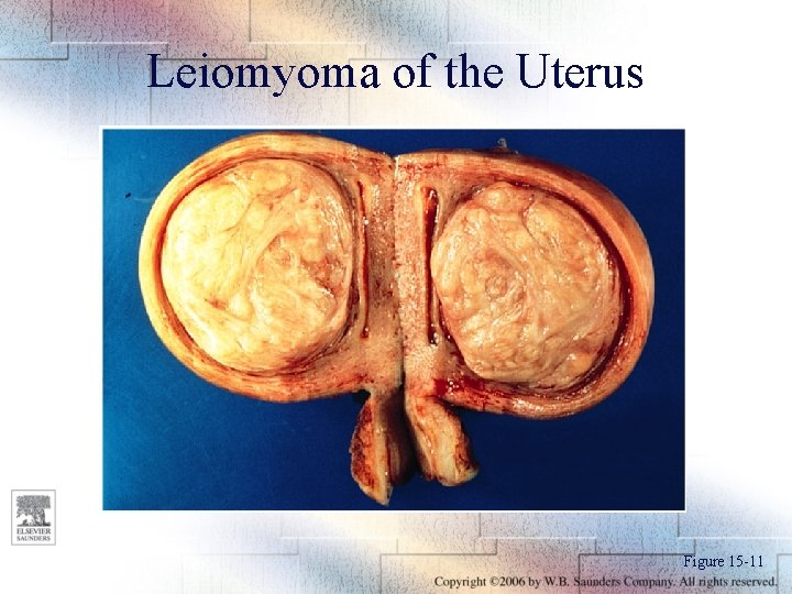 Leiomyoma of the Uterus Figure 15 -11 