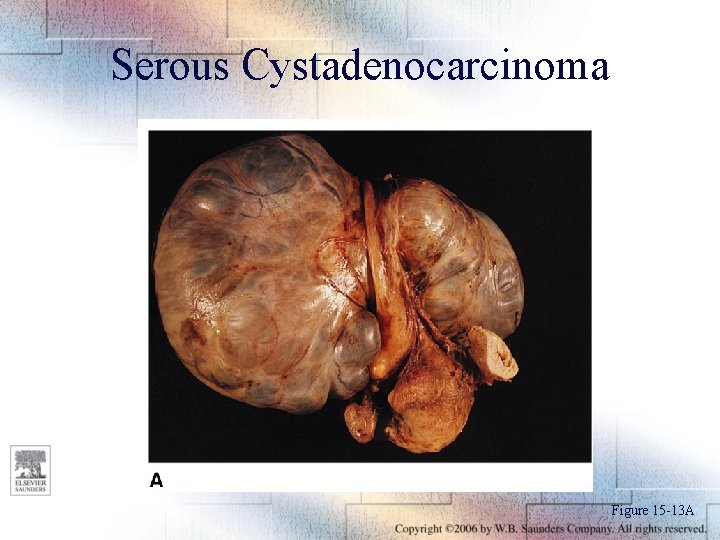 Serous Cystadenocarcinoma Figure 15 -13 A 