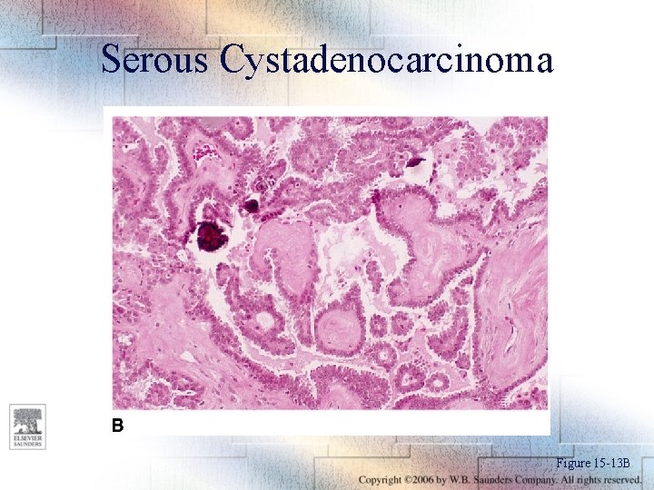 Serous Cystadenocarcinoma Figure 15 -13 B 