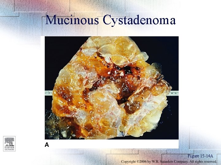 Mucinous Cystadenoma Figure 15 -14 A 