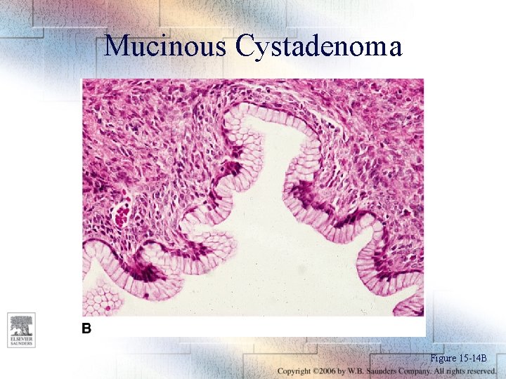 Mucinous Cystadenoma Figure 15 -14 B 