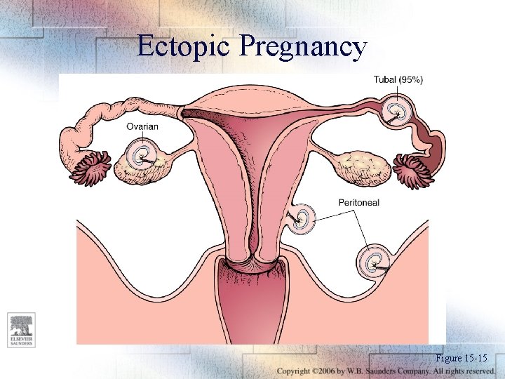Ectopic Pregnancy Figure 15 -15 