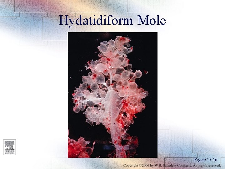 Hydatidiform Mole Figure 15 -16 