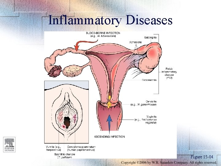 Inflammatory Diseases Figure 15 -04 