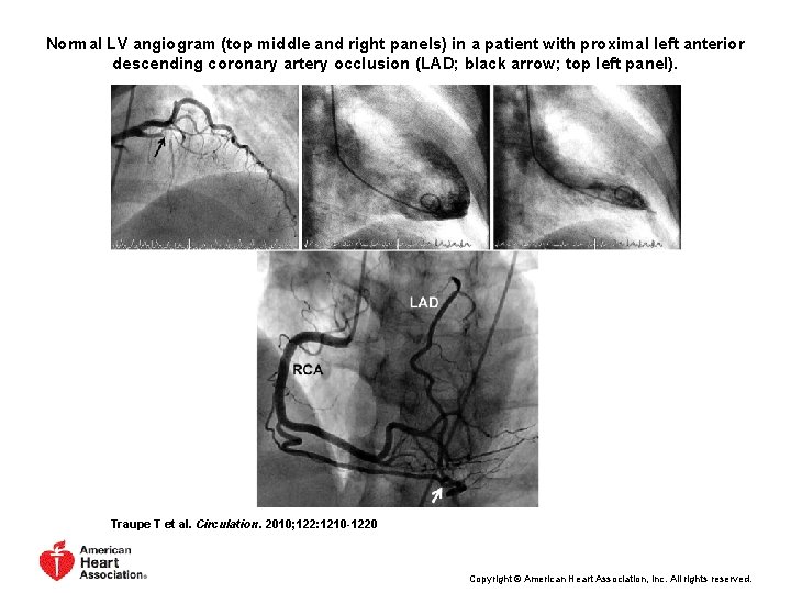 Normal LV angiogram (top middle and right panels) in a patient with proximal left