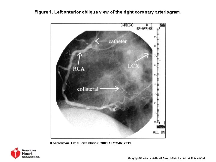 Figure 1. Left anterior oblique view of the right coronary arteriogram. Koerselman J et