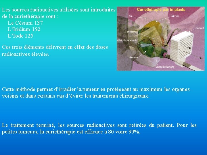 Les sources radioactives utilisées sont introduites lors de la curiethérapie sont : Le Césium