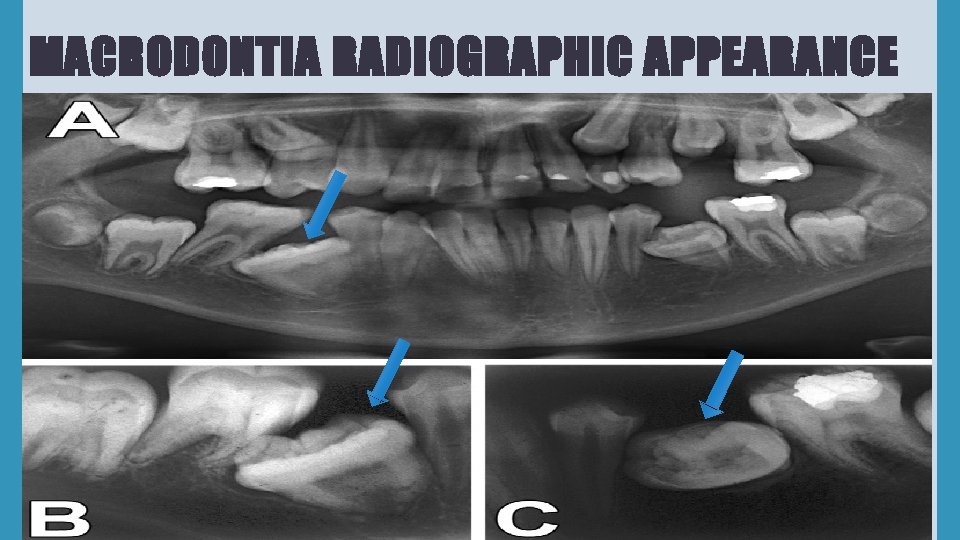 MACRODONTIA RADIOGRAPHIC APPEARANCE 