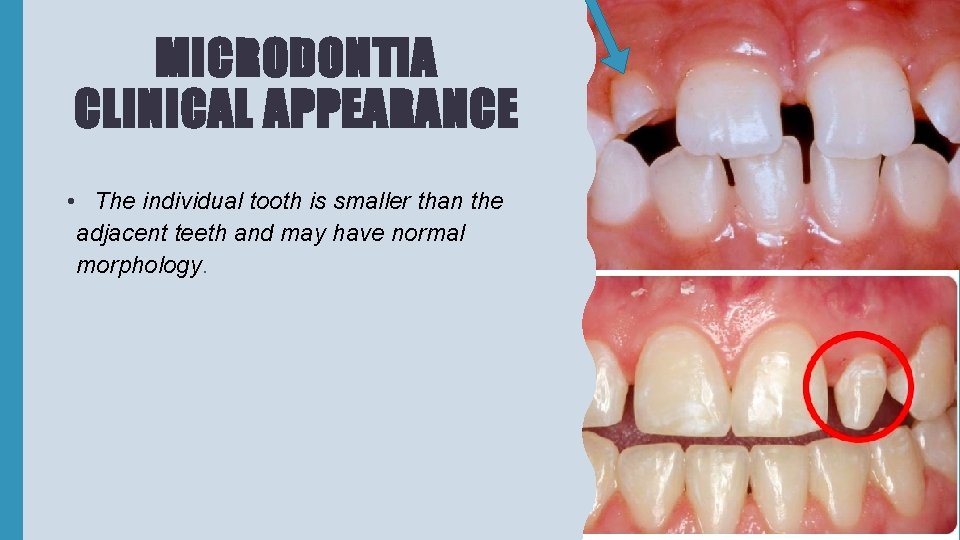 MICRODONTIA CLINICAL APPEARANCE • The individual tooth is smaller than the adjacent teeth and