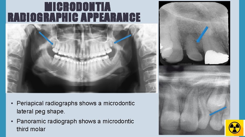 MICRODONTIA RADIOGRAPHIC APPEARANCE • Periapical radiographs shows a microdontic lateral peg shape. • Panoramic