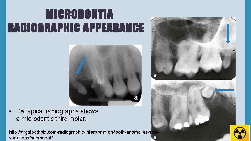 MICRODONTIA RADIOGRAPHIC APPEARANCE • Periapical radiographs shows a microdontic third molar. http: //drgstoothpix. com/radiographic-interpretation/tooth-anomalies/sizevariations/microdont/
