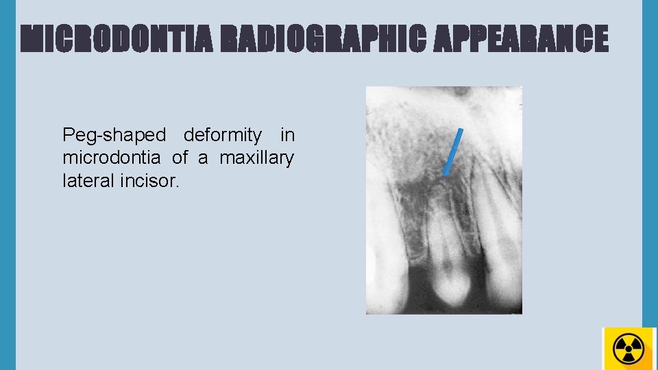 MICRODONTIA RADIOGRAPHIC APPEARANCE Peg-shaped deformity in microdontia of a maxillary lateral incisor. 