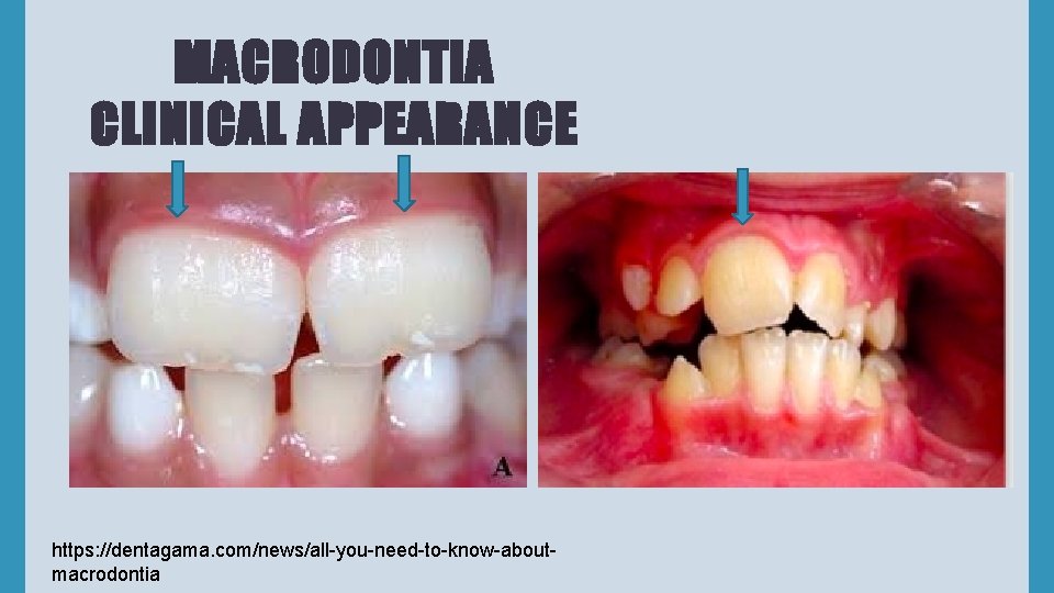 MACRODONTIA CLINICAL APPEARANCE https: //dentagama. com/news/all-you-need-to-know-aboutmacrodontia 