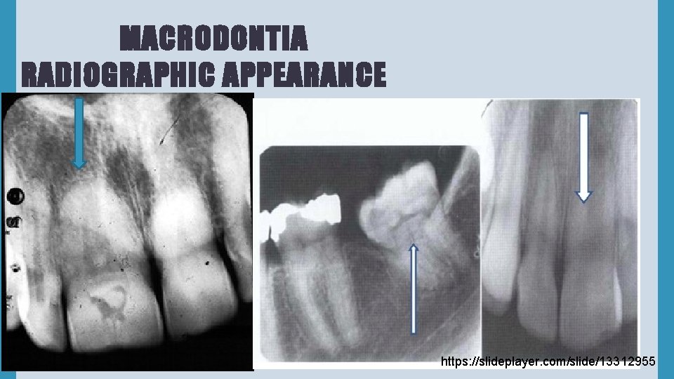 MACRODONTIA RADIOGRAPHIC APPEARANCE https: //slideplayer. com/slide/13312955 