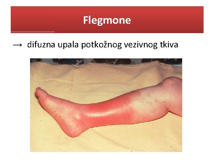 Flegmone → difuzna upala potkožnog vezivnog tkiva 