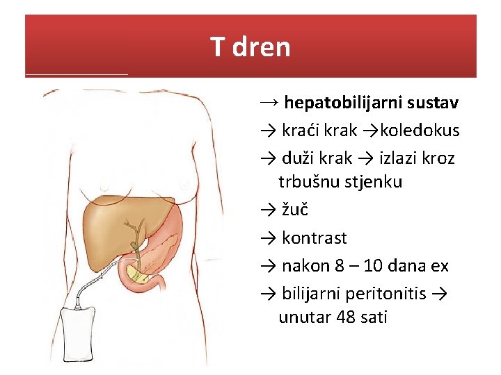 T dren → hepatobilijarni sustav → kraći krak →koledokus → duži krak → izlazi