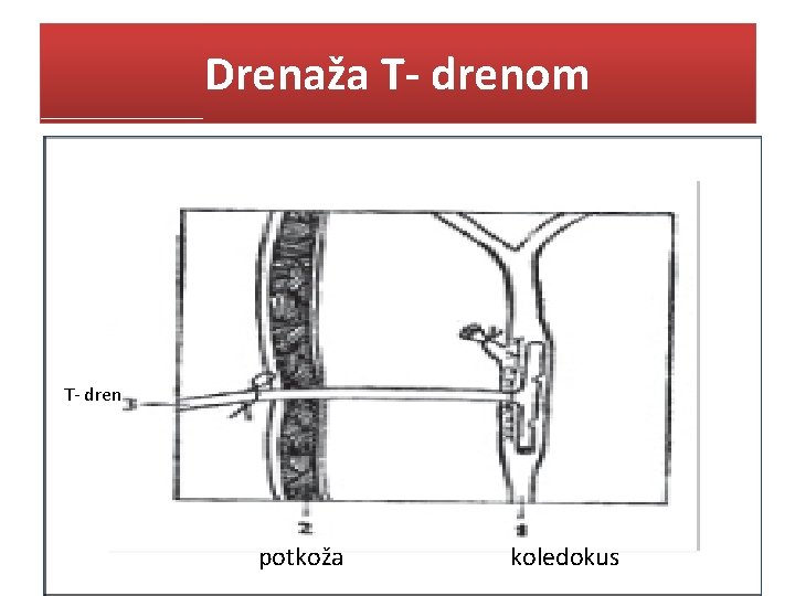 Drenaža T- drenom T- dren potkoža koledokus 