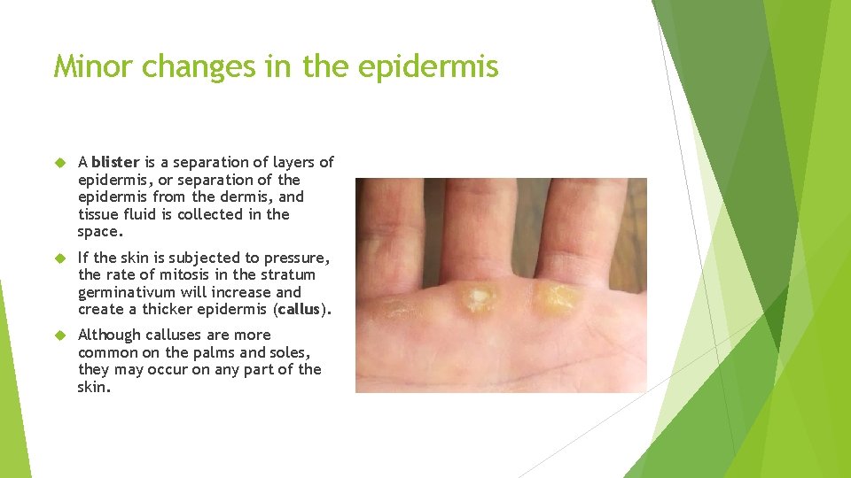 Minor changes in the epidermis A blister is a separation of layers of epidermis,