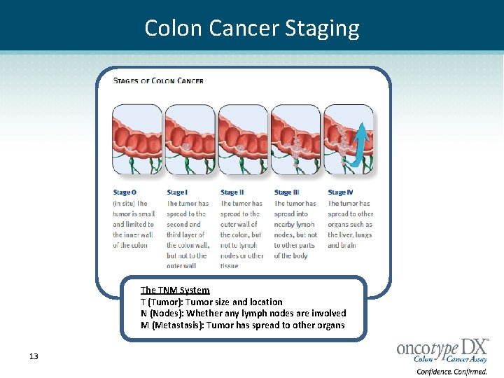 Colon Cancer Staging The TNM System T (Tumor): Tumor size and location N (Nodes):