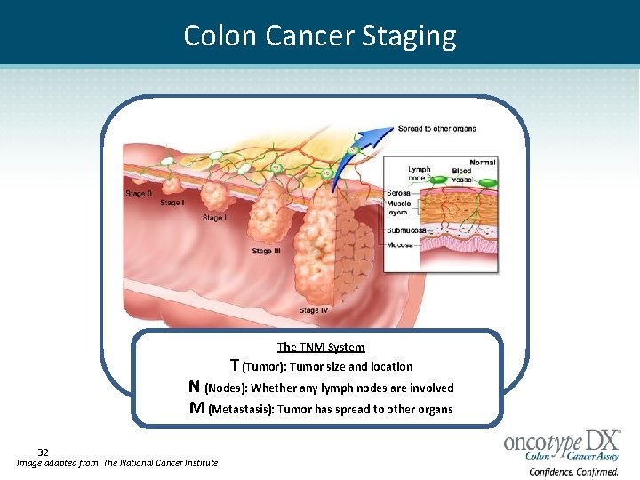 Colon Cancer Staging The TNM System T (Tumor): Tumor size and location N (Nodes):