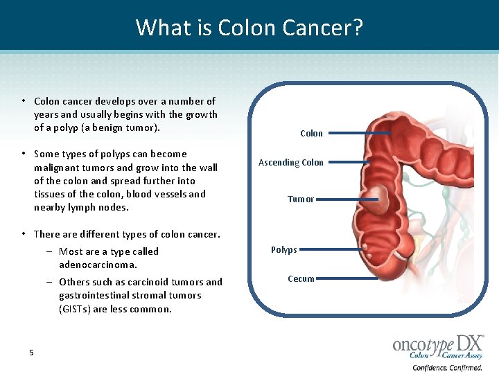 What is Colon Cancer? • Colon cancer develops over a number of years and