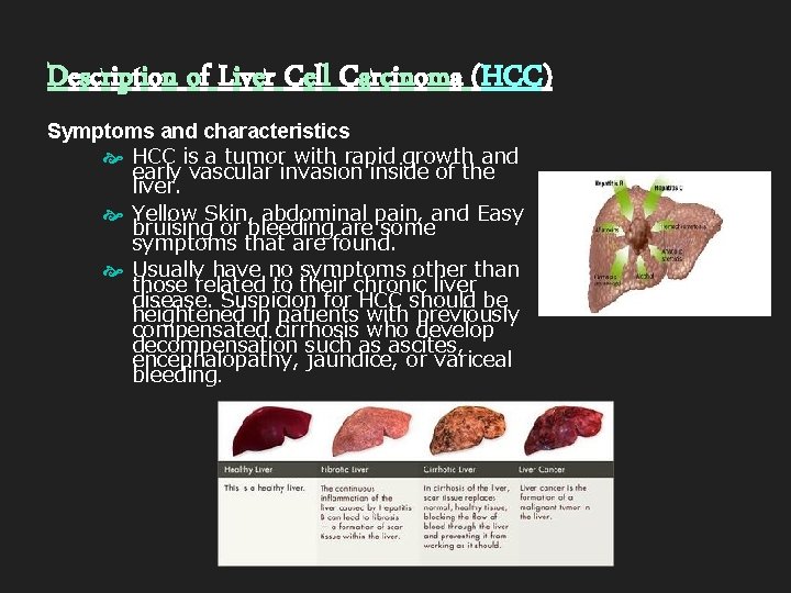 Description of Liver Cell Carcinoma (HCC) Symptoms and characteristics HCC is a tumor with