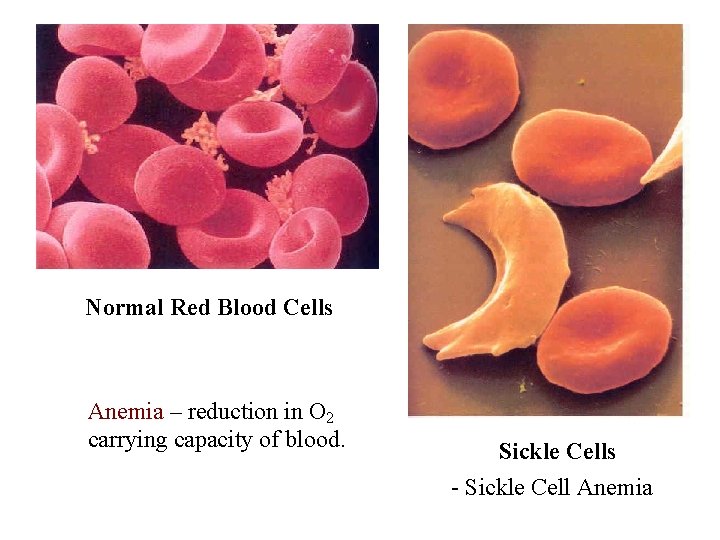 Normal Red Blood Cells Anemia – reduction in O 2 carrying capacity of blood. Normal Red Blood Cells Anemia – reduction in O 2 carrying capacity of blood.