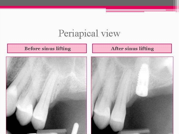 Periapical view Before sinus lifting After sinus lifting 