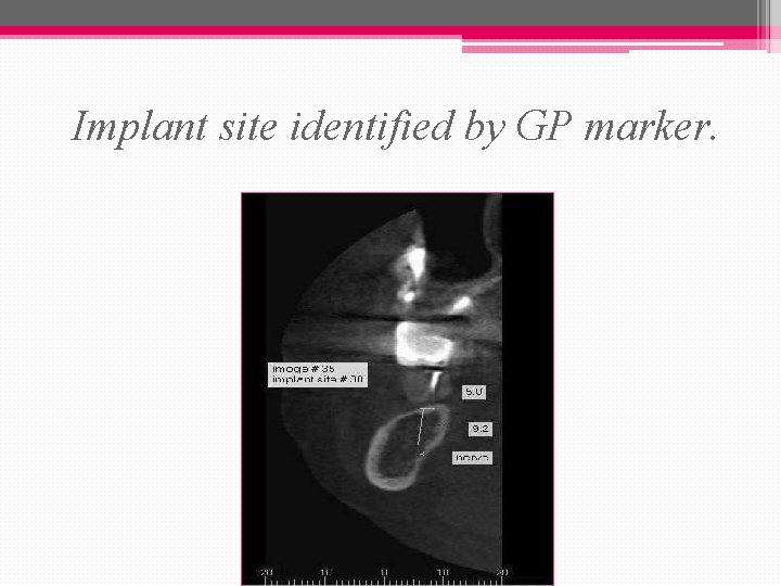 Implant site identified by GP marker. 