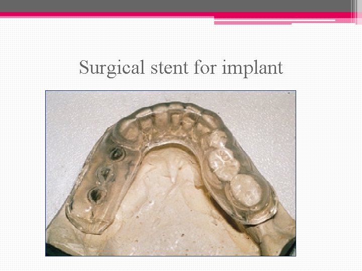 Surgical stent for implant 