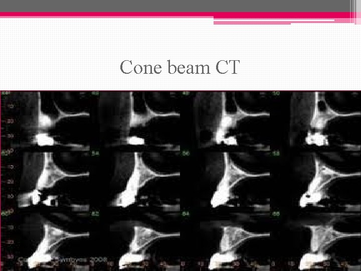 Cone beam CT 