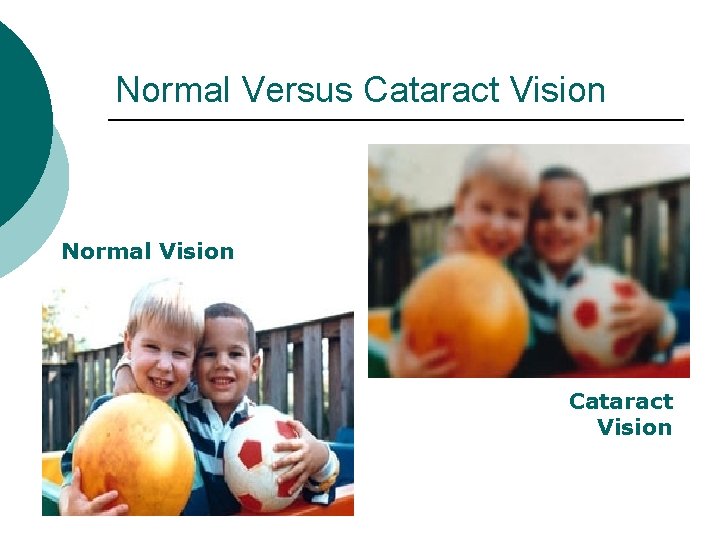 Normal Versus Cataract Vision Normal Vision Cataract Vision 