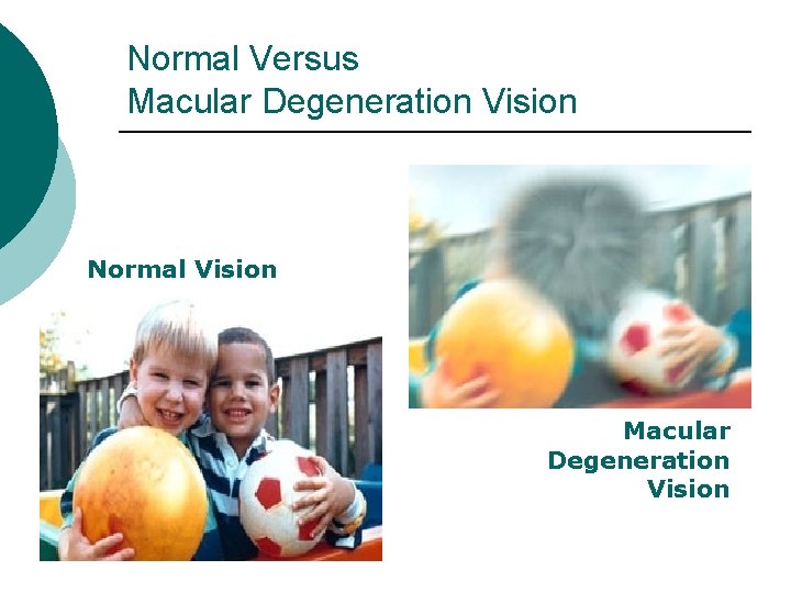 Normal Versus Macular Degeneration Vision Normal Vision Macular Degeneration Vision 