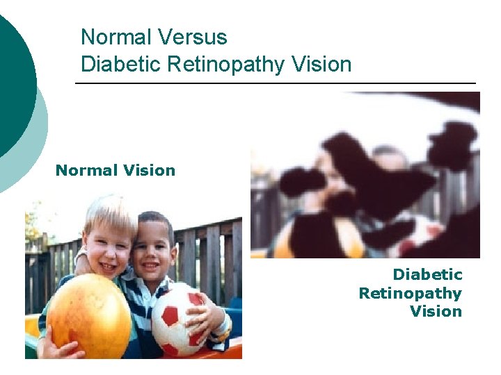 Normal Versus Diabetic Retinopathy Vision Normal Vision Diabetic Retinopathy Vision 