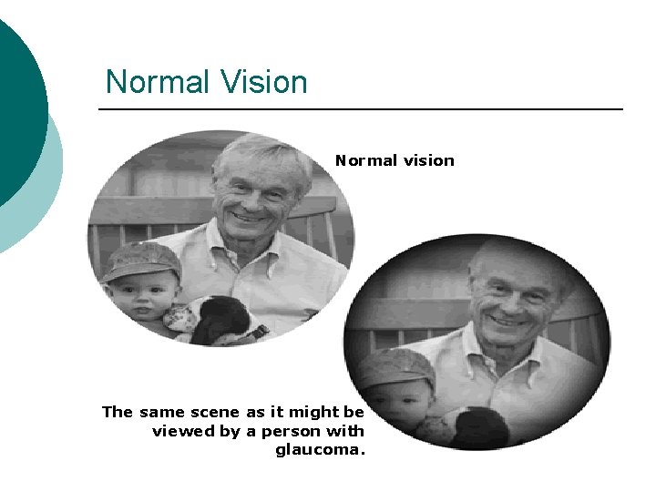 Normal Vision Normal vision The same scene as it might be viewed by a
