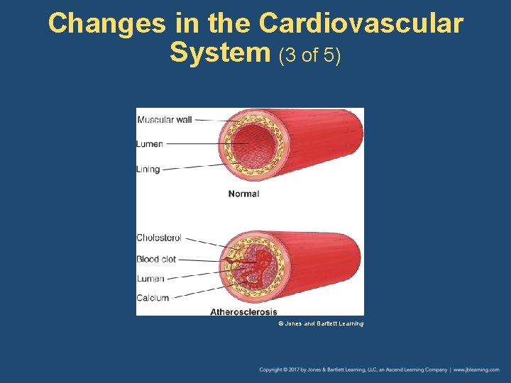 Changes in the Cardiovascular System (3 of 5) © Jones and Bartlett Learning 