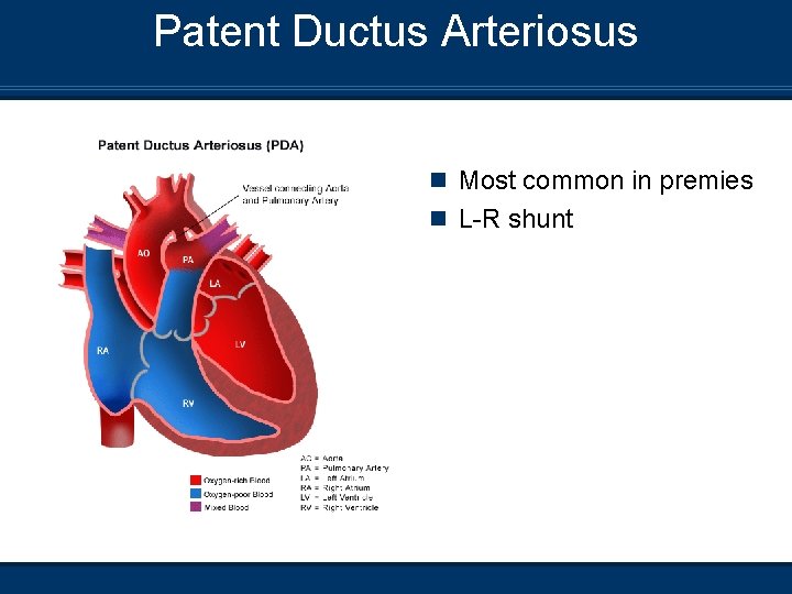 Patent Ductus Arteriosus n Most common in premies n L-R shunt 