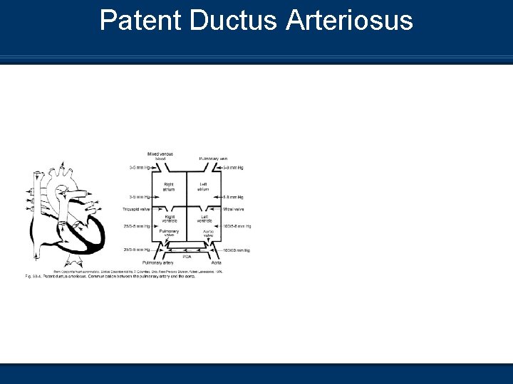 Patent Ductus Arteriosus 