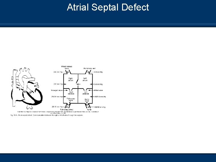 Atrial Septal Defect 