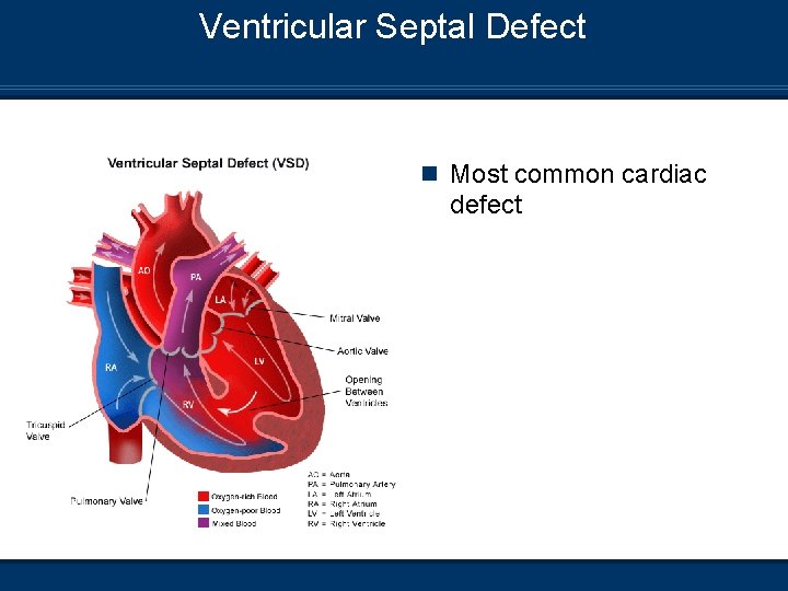 Ventricular Septal Defect n Most common cardiac defect 