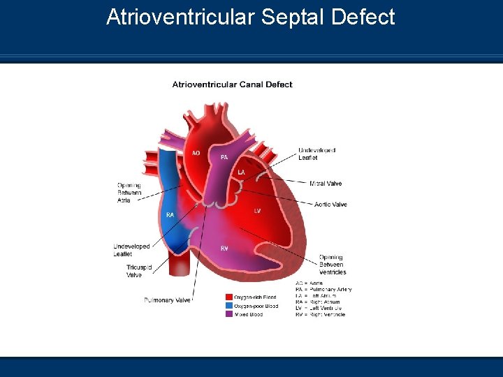 Atrioventricular Septal Defect 