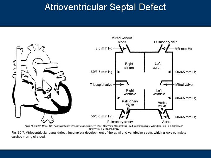 Atrioventricular Septal Defect 
