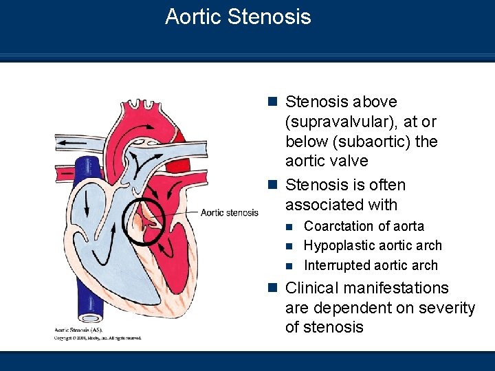 Aortic Stenosis n Stenosis above (supravalvular), at or below (subaortic) the aortic valve n