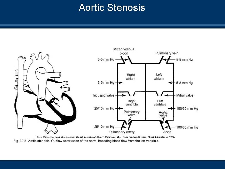 Aortic Stenosis 