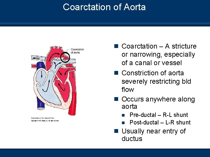 Coarctation of Aorta n Coarctation – A stricture or narrowing, especially of a canal
