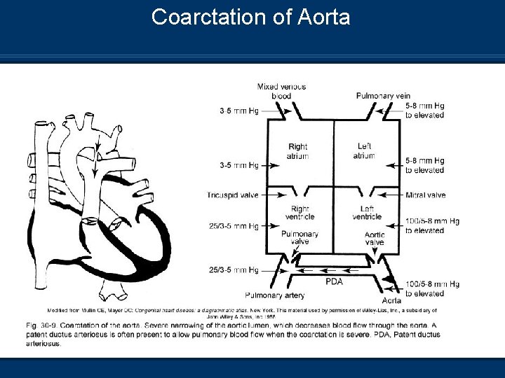 Coarctation of Aorta 