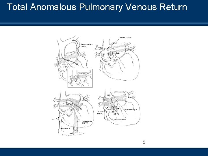 Total Anomalous Pulmonary Venous Return 