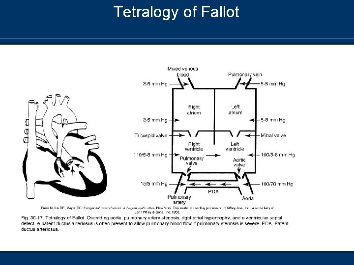 Tetralogy of Fallot 